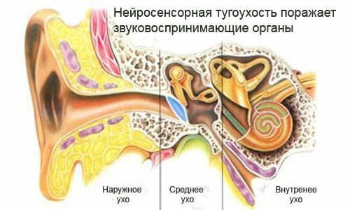 sensorineural hearing loss