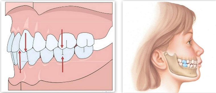 Implantasi email - teknologi modern untuk pemulihan estetika gigi