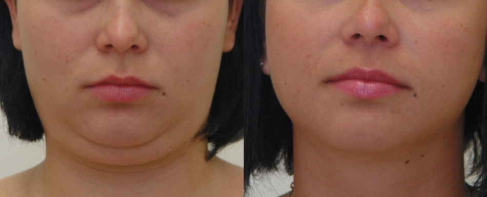 What is laser lipolysis? Laser widolysis of the widow's hump, faces: photos before and after