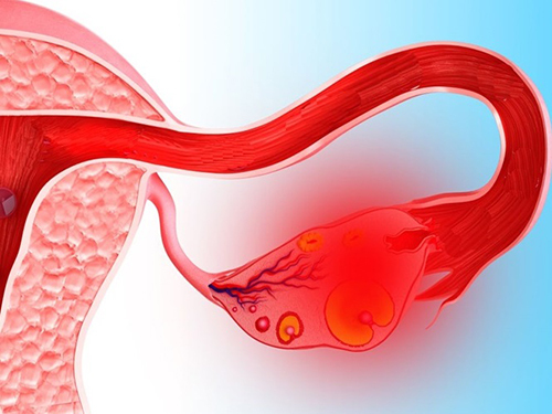 Menstruation after ovarian apoplexy 2