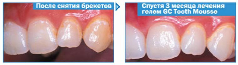 Właściwości aplikacji żelu do remineralizacji GC Tooth Mousse