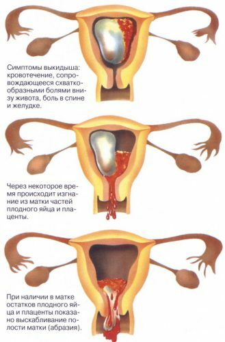 Mensalmente após aborto espontâneo