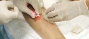 Hur effektiv är behandlingen av åderbråck med en laser?