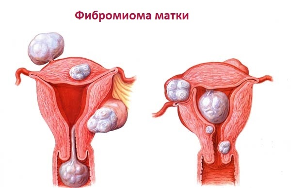 Signs and symptoms of uterine fibroid