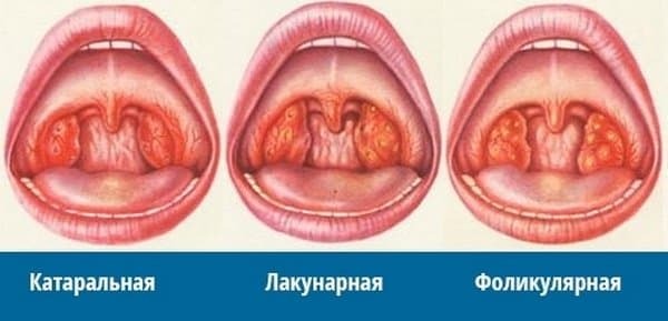 Typer och symptom på akut tonsillit