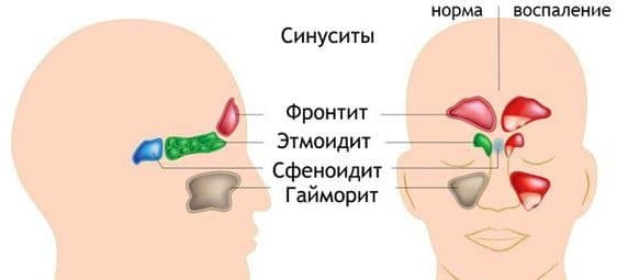 Frontitis: wat zijn de symptomen en hoe wordt de behandeling behandeld?