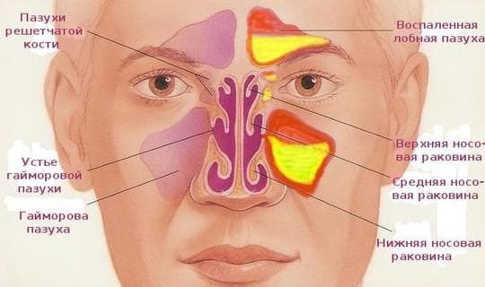 lėtinis maxillary sinusitas yra geriausias būdas