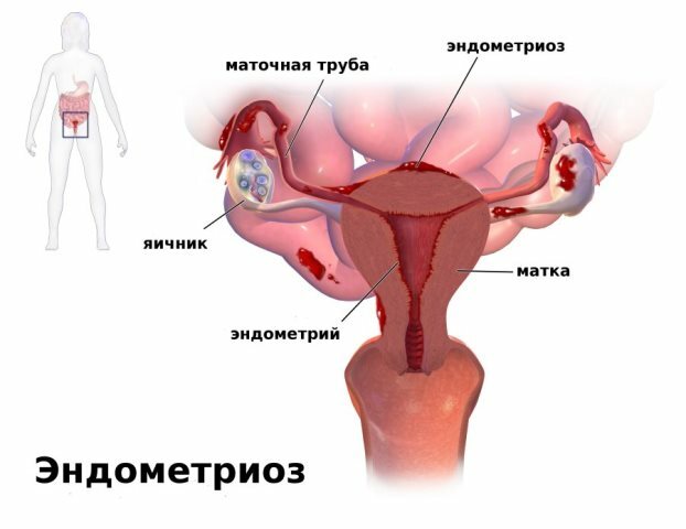 Por que realizar a laparoscopia na endometriose