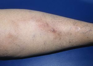 phlebitis of superficial veins