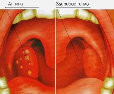 katarrhal angina