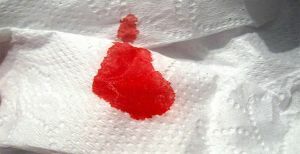 krvarenje s analnim pukotinama