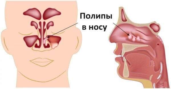 pólipos no nariz