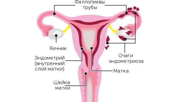 Tips gynecologist: when to do ultrasound in endometriosis