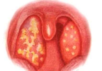 tonsillite acuta necrotica