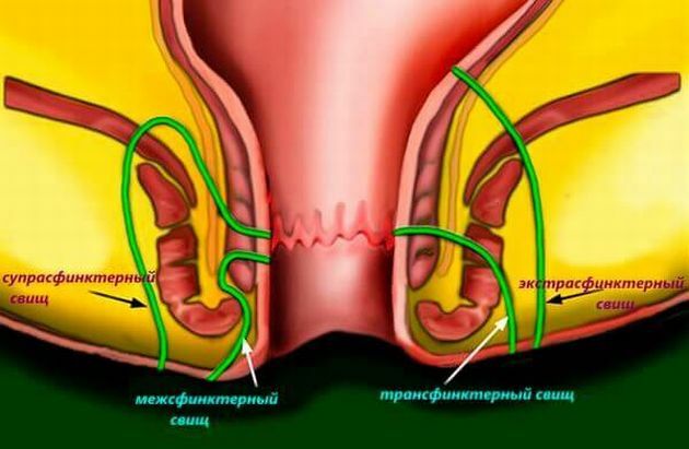 Penyebab, gejala dan metode pengobatan anus fistula