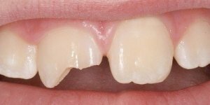 Kiespijn: hoe te verwijderen en wat te doen thuis als een tand pijn doet?