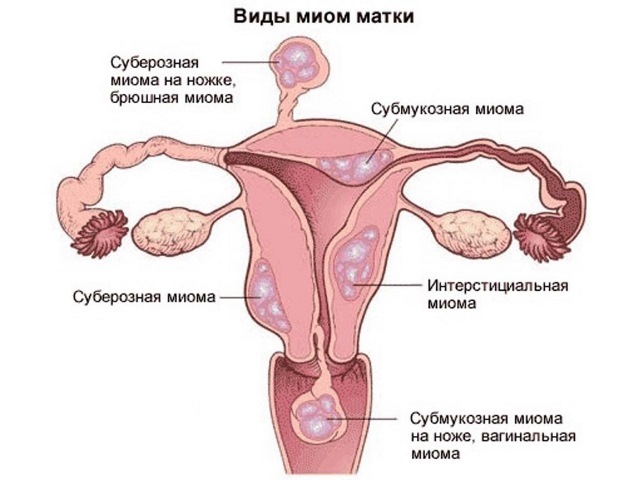 Myoma: will it go away or should it be treated?