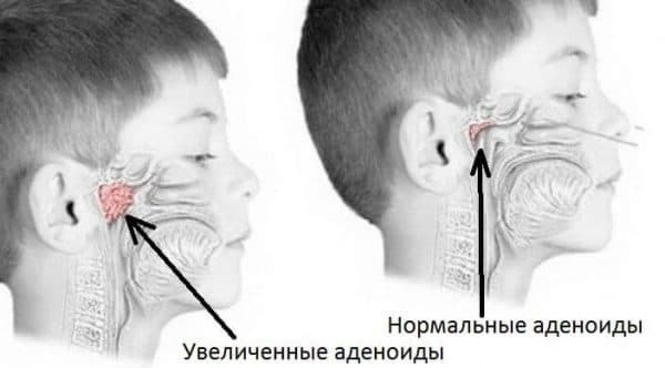 Jak pokonać przewlekłe zapalenie błony śluzowej jamy ustnej u dzieci