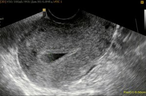 Bulanan untuk endometritis 1