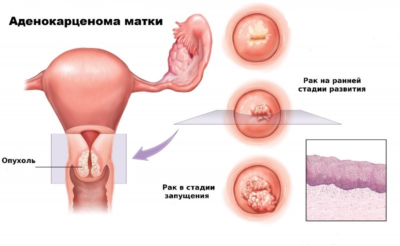 Adenocarcinoma perigoso do útero: como não perder "sinais alarmantes" e o que fazer se detectar