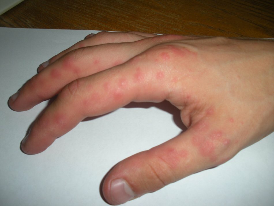 What should I do if the skin is on my fingers? Treatment and prevention