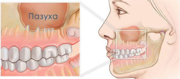 odontogene sinusitis