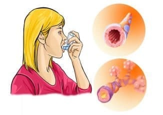 allergische bronchitis