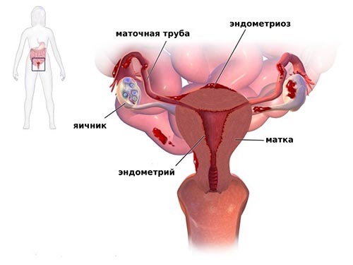 Menstruasi setelah Buserelin 71