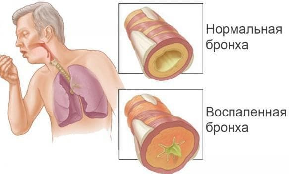 Bronchitis als veroorzaker van hoest