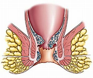 trombose