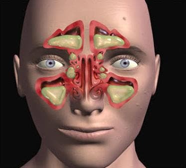 bilateral sinusitis