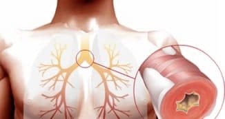 bronchitis bij volwassenen