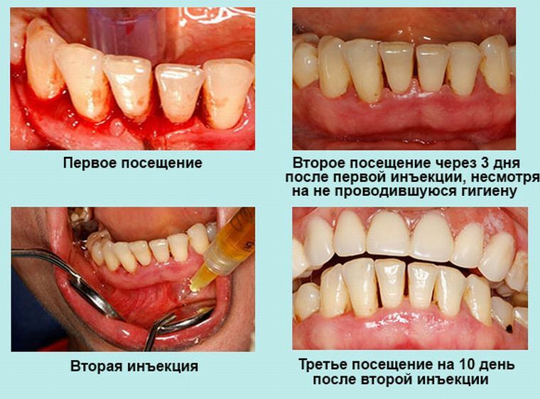 Objetivos e características do plasmolifting em odontologia