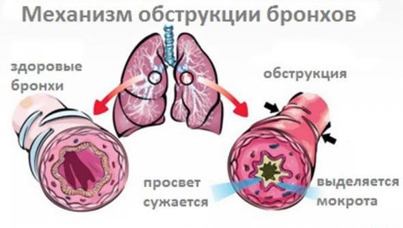 obstructieve bronchitis bij kinderen met symptomen en behandeling