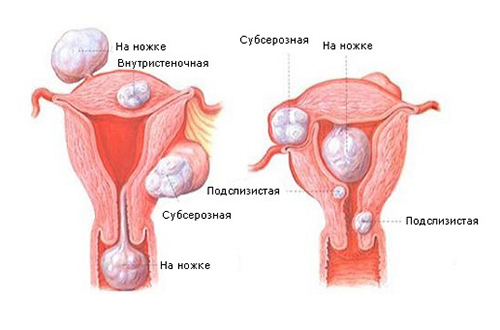 Methods of treatment of uterine fibromatosis