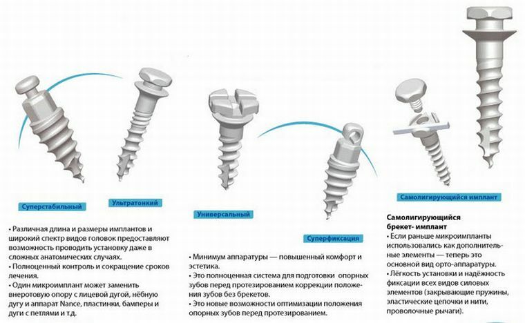 Ortodonikus mini implantátumok - új fogalom a fogpótlásokban