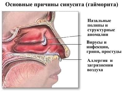 veroorzaakt maxillaire sinusitis