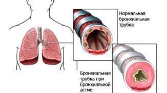 allergische bronchitis code van microbieel 10