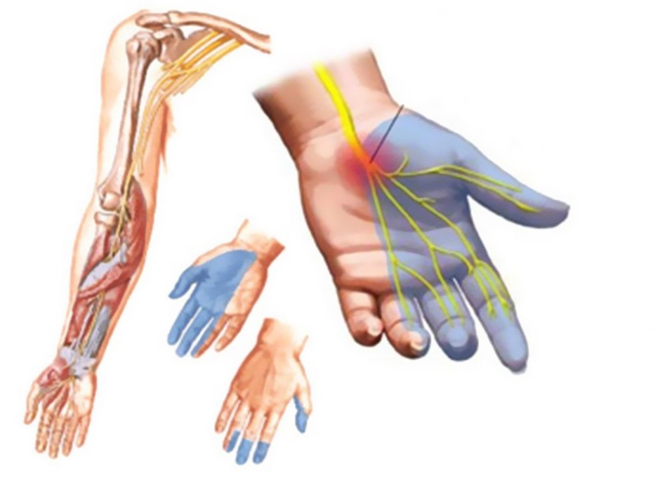 Fingers fingers: causes. What should I do if my fingers become numb?