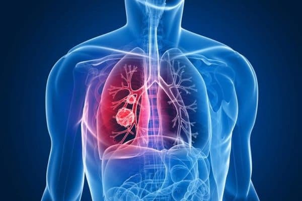 treatment of chronic bronchitis in adults