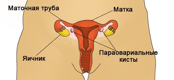 What is a special multi-chamber ovarian cyst?