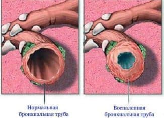 behandeling van chronische bronchitis bij volwassenen