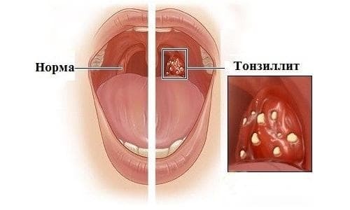 chronische tonsillitis