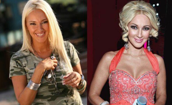 Photos of Lera Kudryavtseva - before and after plastics