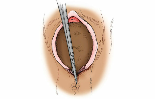 Úlcera perineal pós-parto: sintomas, diagnóstico, tratamento