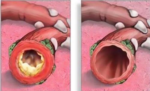 atrofische tracheitis bij kinderen