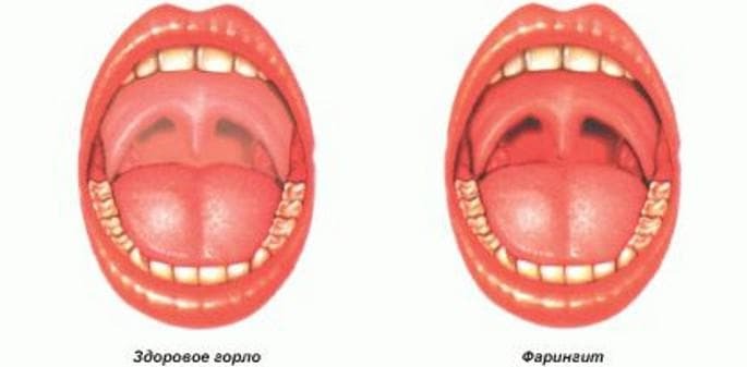 streptococcus in the scheme