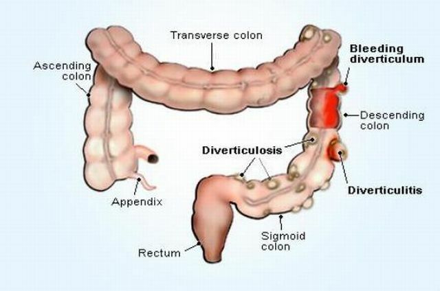 Cara mencegah dan menyembuhkan diverticulosis pada kolon sigmoid