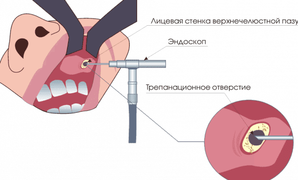 endoscopie van odontogene sinusitis