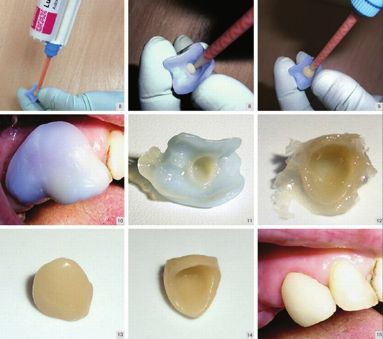 Coroas de plástico como próteses temporárias